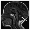 Figure 2. . MRI of cerebellar hypoplasia in an individual with Hoyeraal Hreidarsson syndrome.