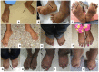 Figure 2. . Feet of different individuals with MONA at ages 5 years (A), 6 years (B,C), 7 years (D,E), 9 years (F), 10 years (G), 13 years (H,I), and 15 years (J).