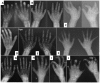 Figure 4. . Radiographs of the hands of different children with MONA at age 4 years (A), 5 years (B), 6 years (C,D), 7 years (E), 9 years (F), 10 years (G), 11 years (H), and 13 years (I,J).
