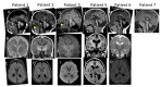 Figure 2. . Magnetic resonance images of six individuals who are heterozygous for a recurrent p.